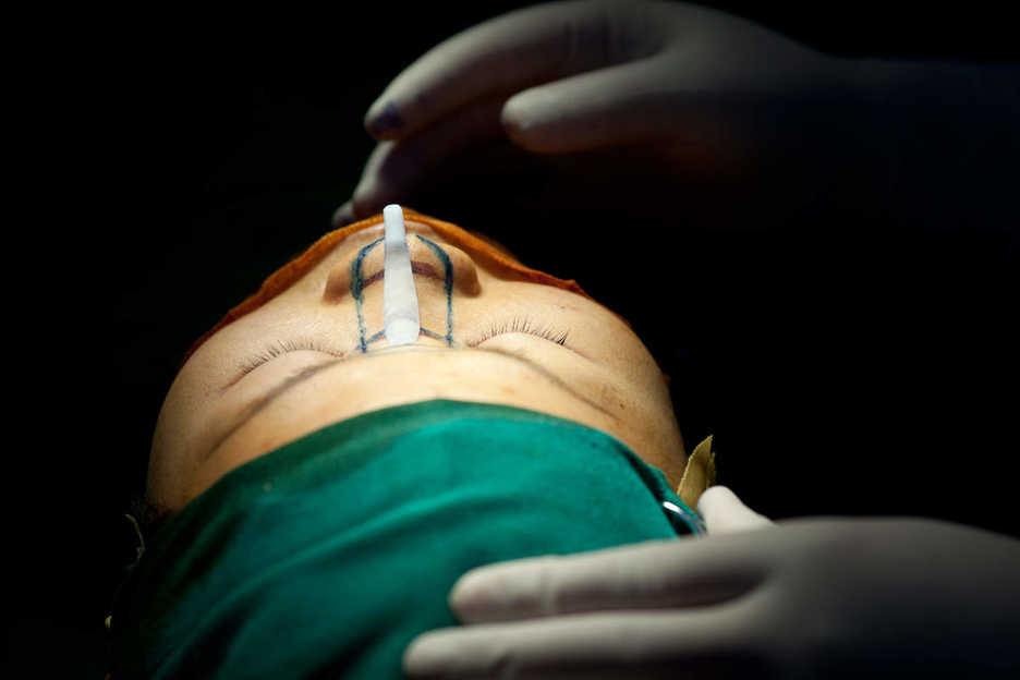 Preparing an artificial insert during a nose-enlargement operation in China