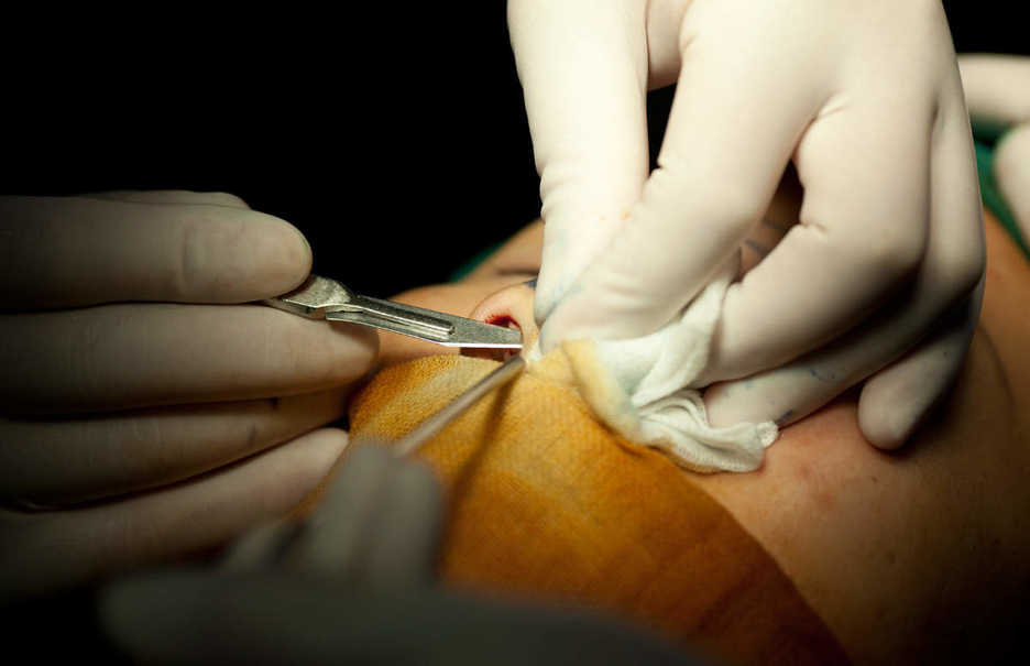 Cutting a patient's nose during a nose-enhancement operation in Shenzhen, China