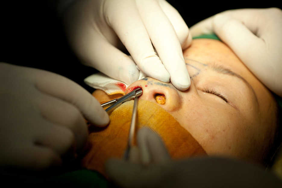 Nose enhancement operation at Shenzhen Humanity Hospital in Louhu